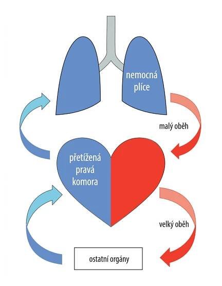 Plicní hypertenze - Sdružení pro srdeční rytmus, spolek