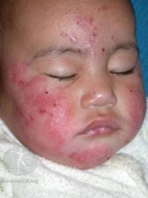 atopic eczema on infant face