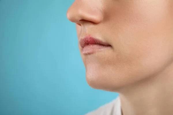 Žena trpící herpes na světle modrém pozadí, detailní záběr. Mezera pro text — Stock obrázek