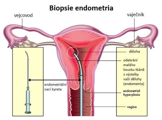 Biopsii endometria provádí obvykle gynekolog nebo specialista na reprodukční medicínu