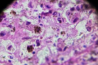 melanom biopsie pod mikroskopií - melanom - stock snímky, obrázky a fotky