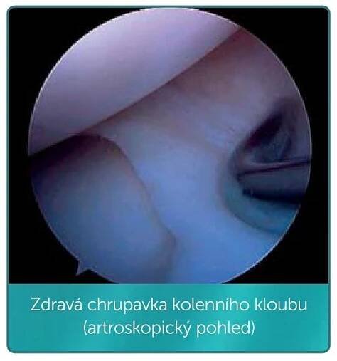 artroza pred