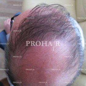 PROHAIR-hair-transplant-clinic-9000-FUE-03
