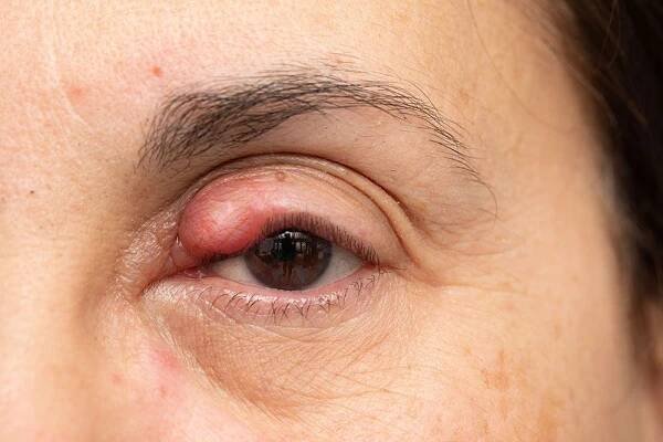 Chalazion na oku dámy, otok a zánět horního víčka. Zčervenání vyvolané alergií — Stock obrázek