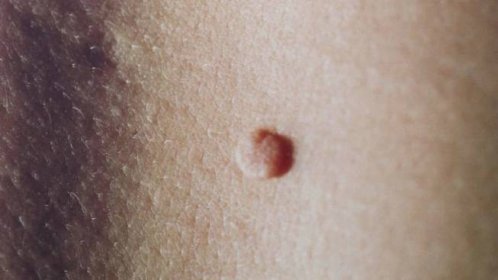 Pozor na melanom: Kožní lékaři dnes nabídnou vyšetření znamének