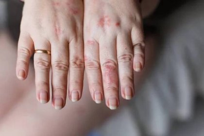 Obrázek ženských rukou jeden oteklé v důsledku vosí žihadlo. Alergií na červené skvrny na kůži. Koncepce zdraví — Stock obrázek