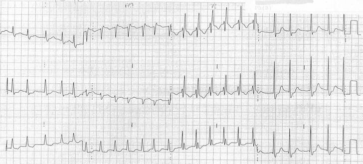 ECG complete RBBB, broad QRS, M-shaped V1, Wide slurred s wave lateral leads (I, aVL, V5-V6) 
