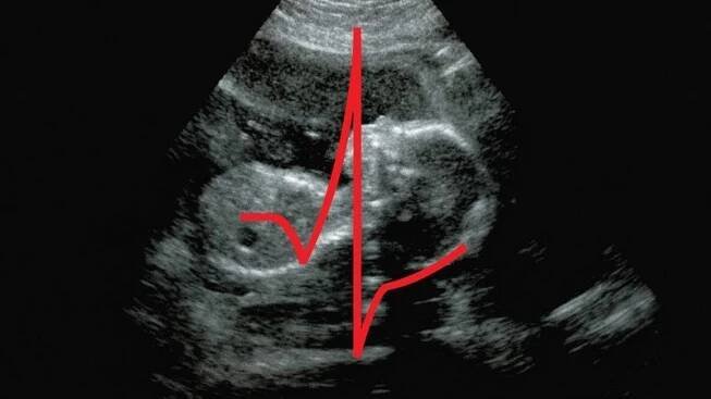 Diagnostikování srdečních chorob již v těhotenství - Novinky