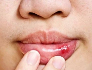 Účinné způsoby, jak zabránit vzniku nepříjemných aftů v ústech