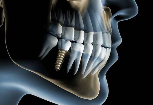Bazální implantace zubů - výhody metody / Články