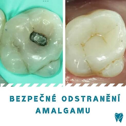 odstran-n-amalgamu.webp