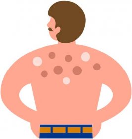 Common Causes of Lumps on the Back - From This One Place