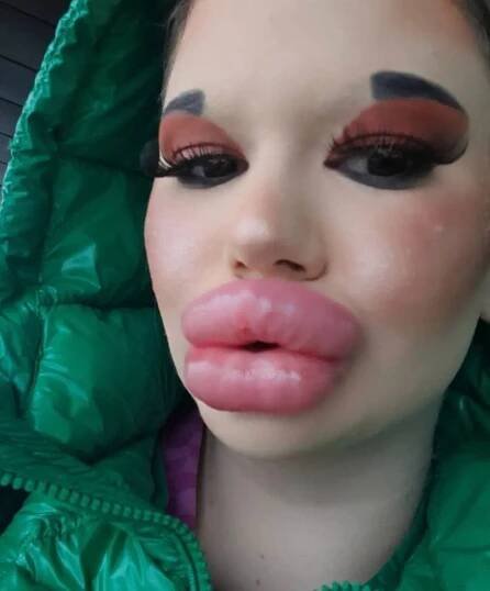 Dívka chce mít největší rty na světě: podstoupila už 26 injekcí - Zivot
