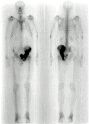 Obrázek č. 3: Celotělová scintigrafie skeletu