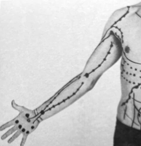 Arm with Trigger Points Drawn On It