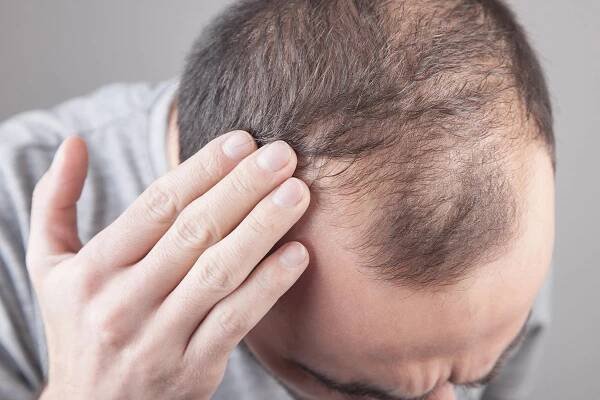 Hair Transplant - DrT Hair Best Hair Transplant