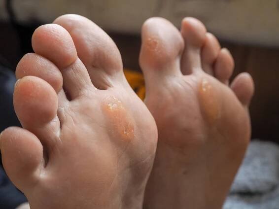 zblízka k calluses. bolestivá kukuřice pěšky. - kuří oko - stock snímky, obrázky a fotky