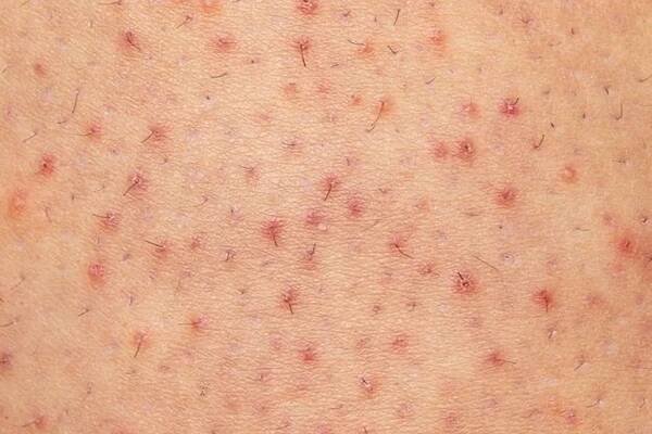 IPL Phototherapy