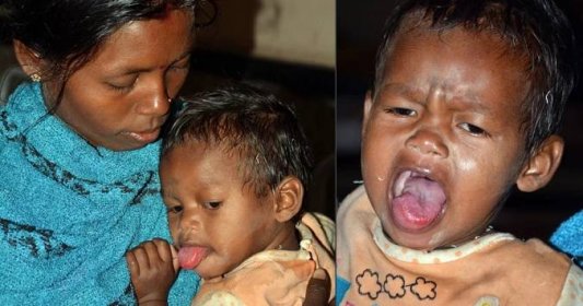 Dívenka (1,5) trpí vzácnou nemocí: Nádor v jazyku ji pomalu dusí k smrti