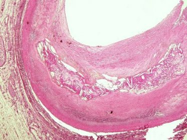 Soubor:Ateroskleróza koronární arterie (30B).jpg – WikiSkripta