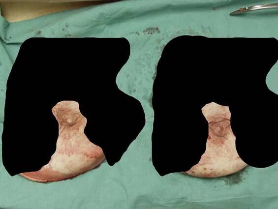 Rekonstrukce prsu po masektomii | Plastická a estetická chirurgie - Luboš Dražan