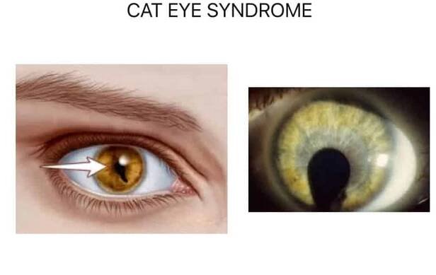 Cat-eye syndrome