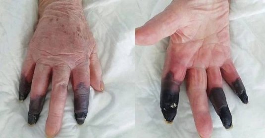 AKTUÁLNÍ: Starší ženě museli amputovat tři prsty po onemocnění na covid-19: Zvláštních a nebezpečných příznaků nově několik přibývá!