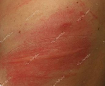 Vyrážka na citlivou kůži nebo kožní problémy s alergii vyrážka