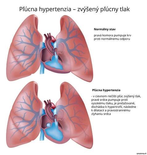 Pľúcna hypertenzia - príznaky a liečba