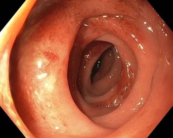 Segmental colitis associated with diverticulosis