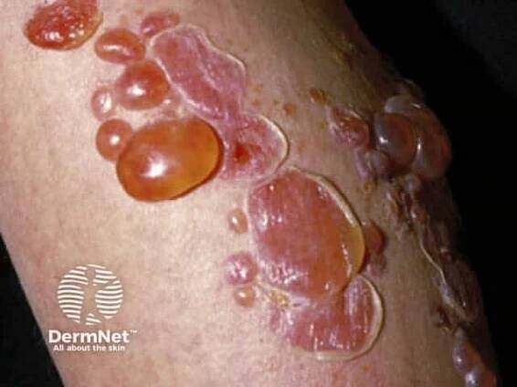 Impetigo Images — DermNet