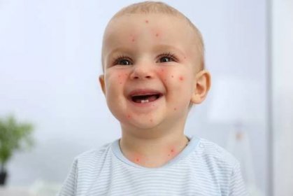 Plané neštovice postihují především malé děti.