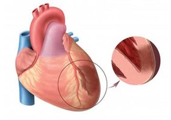 Rozsáhlý infarkt srdce / Infarkt myokardu | Užitečné informace a tipy na péči o sebe. Zdraví, výživa a další.