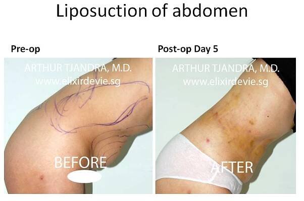 Liposuction Before and After photos by Dr Arthur Tjandra of L’Élixir de Vie Page 1