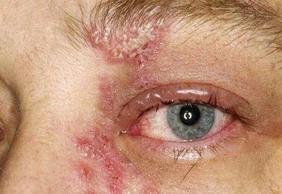 Herpes na očích naznačuje oslabený imunitní systém / Články