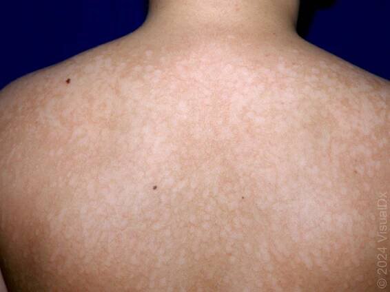 Tinea Versicolor (Pityriasis Versicolor)