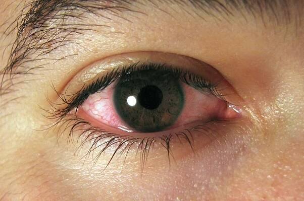 DRY EYE SYNDROME | TUCKER EYE CARE | FAYETTEVILLE, NY 