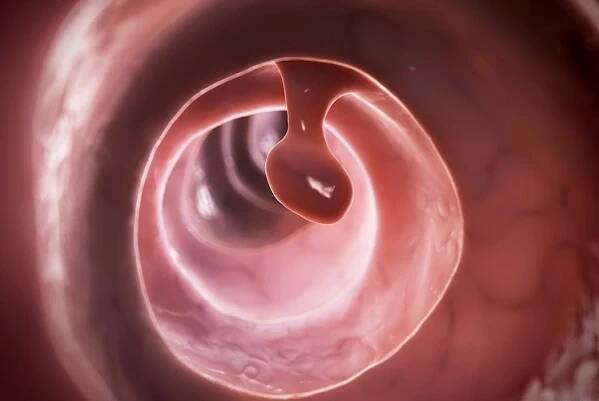 Colon polyps (bowel polyps)