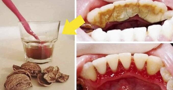 Zubní kámen nepodceňujte, může vést dokonce až k zánětu dásní a ke ztrátě zubů! Jak se ho zbavit přírodní metodou a co dělat pro prevenci před jeho vznikem?