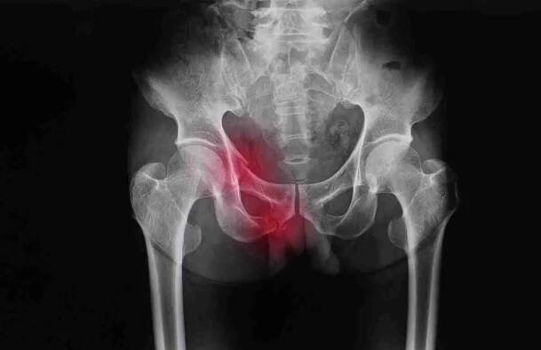 Pelvis,X-ray,Of,A,Patient,Showing,Superior,And,Inferior,Pubic