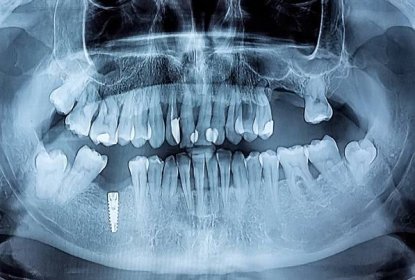 Proč nejsou zubní implantáty bezstarostné řešení na celý život - Nechci kazy