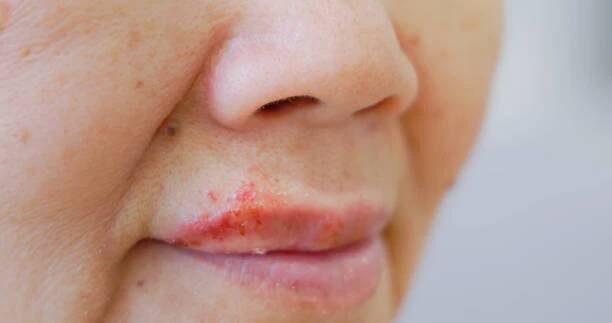 asian elder cold sores problem - opary oparech - stock snímky, obrázky a fotky