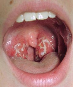 Bílý povlak na jazyku dospělého: příčiny a léčba