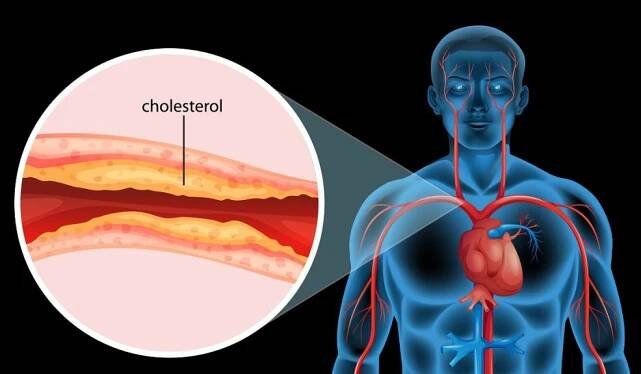 Pozor: Cholesterol je hlavní příčina úmrtí ve světě, v počáteční fázi tohoto onemocnění je teď 60 % Čechů