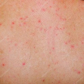 Stáhnout - Alergická vyrážka dermatitida zpět kůže pacienta — Stock obrázek