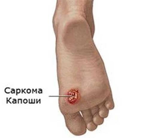 Kaposiho sarkom / Sarkom