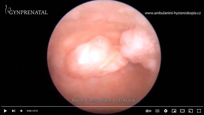 Chráněno: kapitola Endometriální polyp 