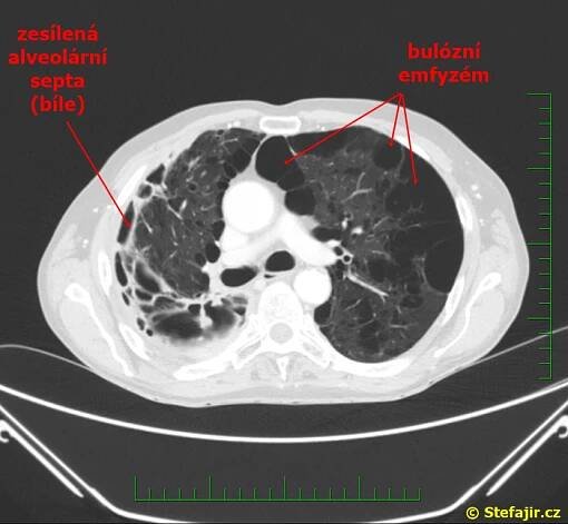 Nález 30 - Bulózní emfyzém s tumorem plic | Medicína, nemoci, studium na 1. LF UK
