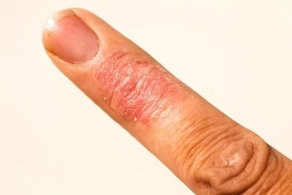 Nemocný Dematitis alergické kožní vyrážka ekzém prst — Stock obrázek