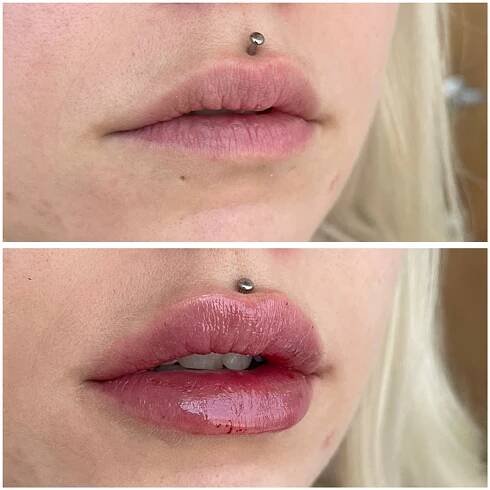 Before & Afters of Lip Filler, Botox, Sculptra & Laser in Colorado